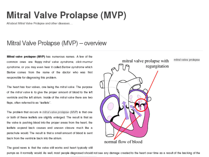 www.mitral-valve-prolapse.com