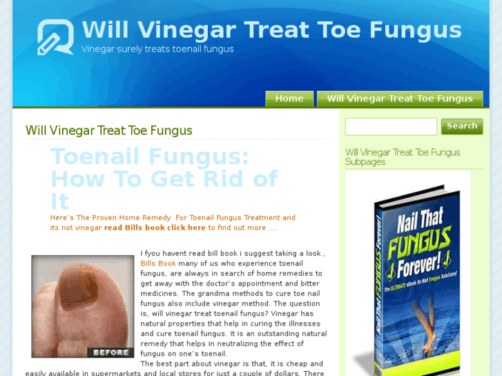 www.willvinegartreattoenailfungus.com