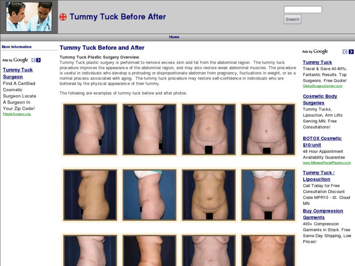 www.tummytuckbeforeafter.com