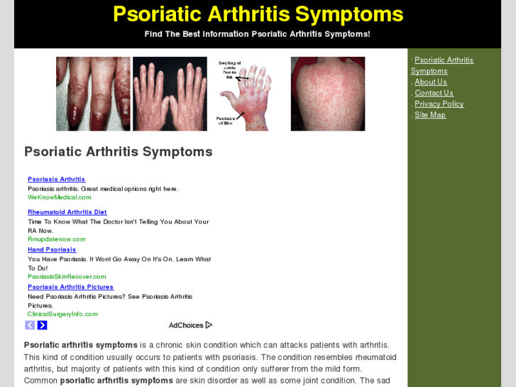 www.psoriaticarthritissymptoms.net