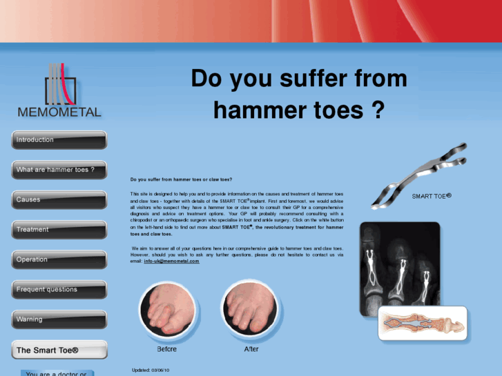 www.hammertoe-clawtoe.com