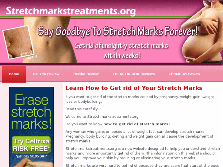 www.stretchmarkstreatments.org