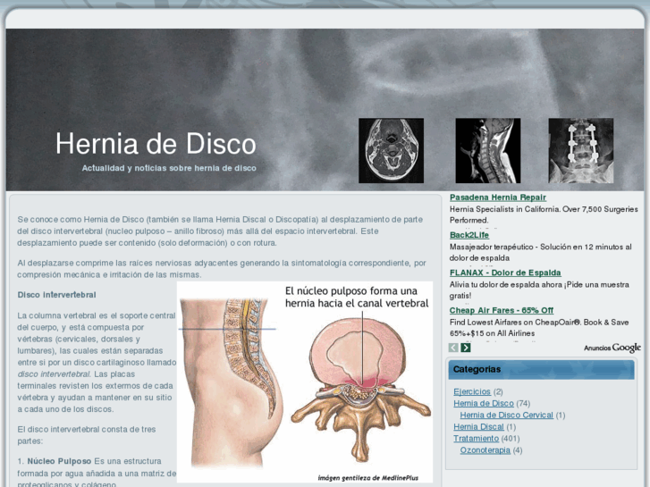 www.herniadedisco.es