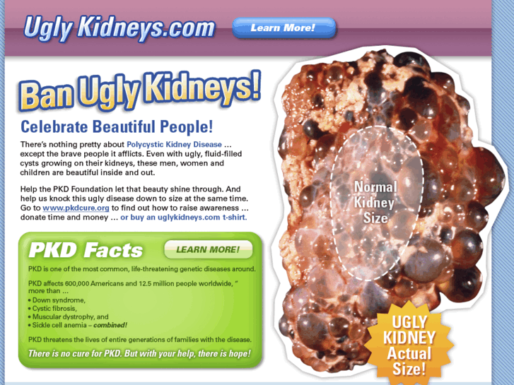 www.uglykidney.net