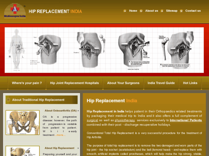 www.hipreplacementindia.com