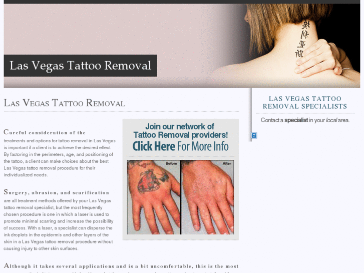 www.lasvegastattooremoval.net