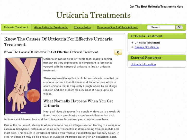 www.urticariatreatments.com