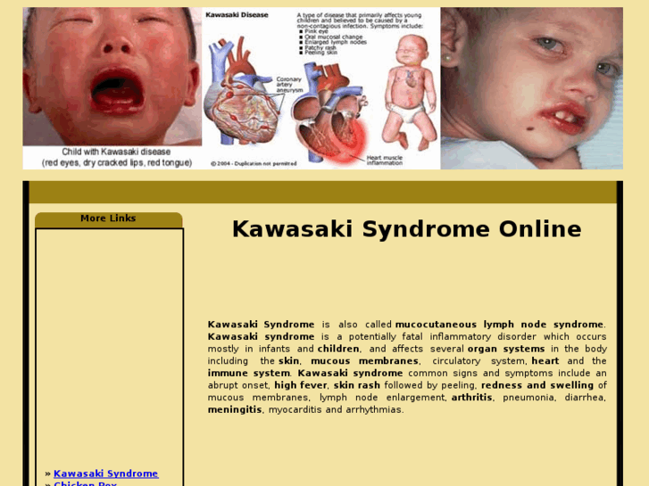 www.kawasakisyndrome.org