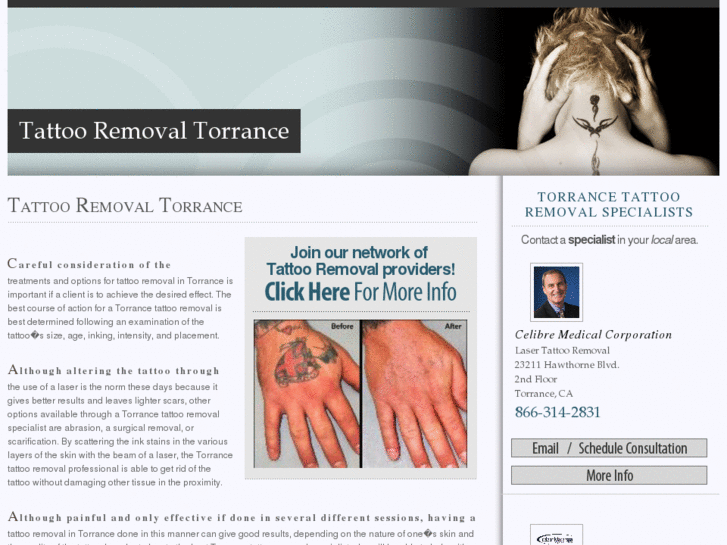 www.torrancetattooremoval.com