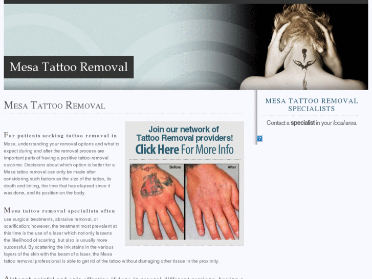 www.mesatattooremoval.com