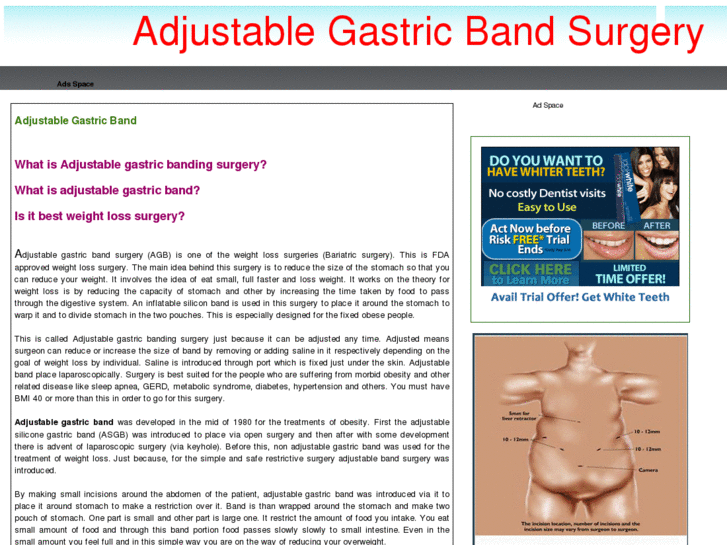 www.adjustablebandsurgery.com