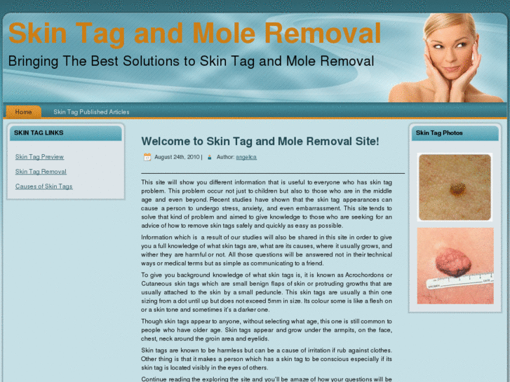 www.skin-tag-removal.net