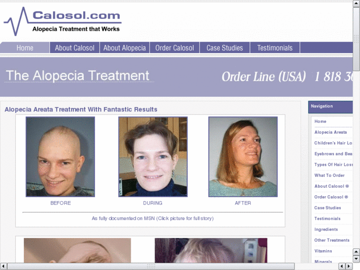 www.alopecia-areata-treatment.com