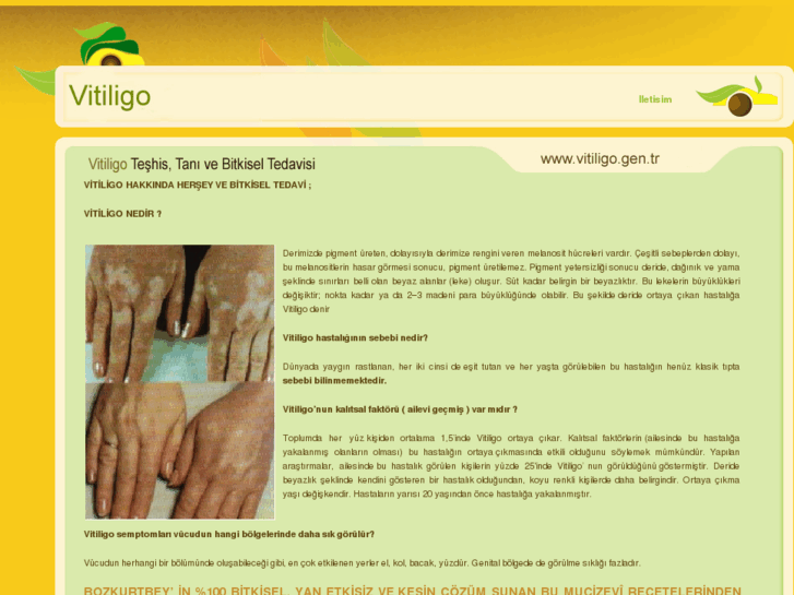 www.vitiligo.gen.tr