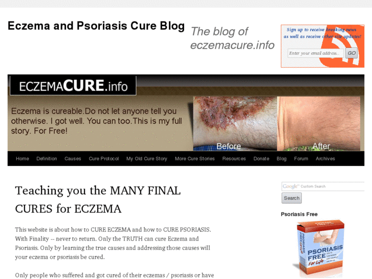 www.eczemacure.info