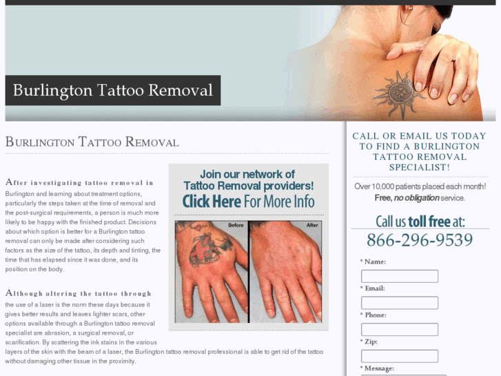 www.burlingtontattooremoval.net