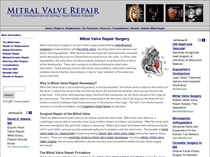 www.mitralvalverepairsurgery.com