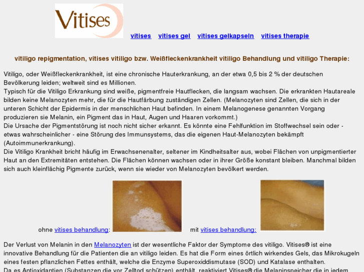 www.vitiligo-repigmentation.com