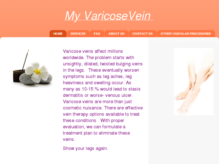 www.myvaricosevein.com