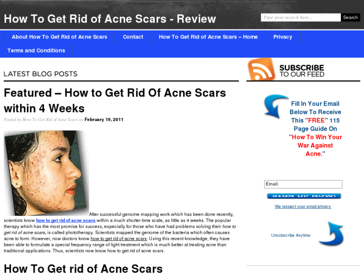 www.howtogetridofacnescars.biz