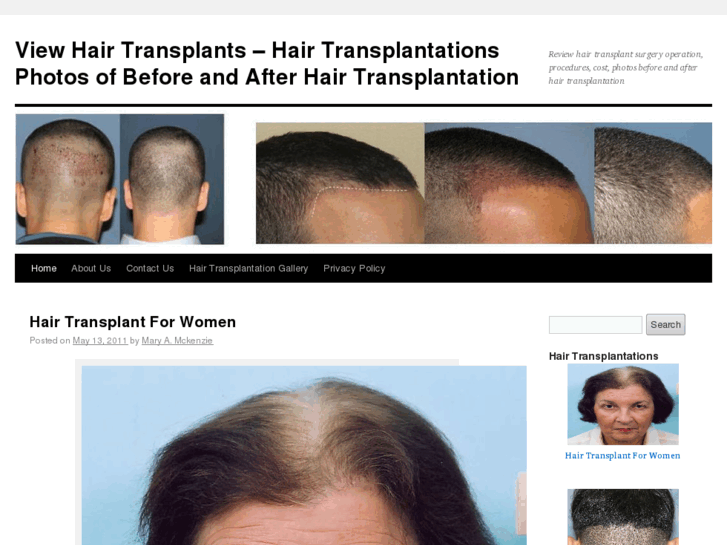 www.hair-transplantations.com