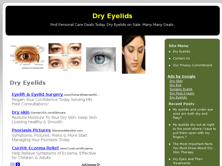 www.dryeyelids.net