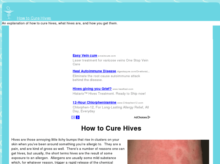 www.howtocurehives.com