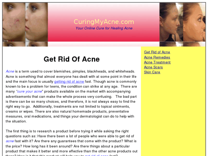 www.curingmyacne.com