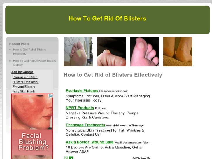 www.howtogetridofblisters.com