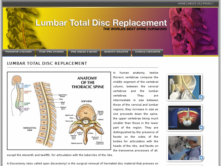 www.lumbartotaldiscreplacement.info