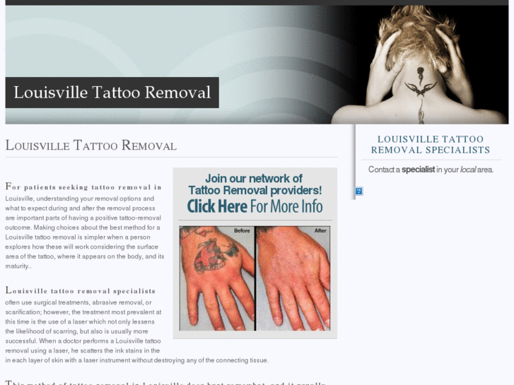 www.louisvilletattooremoval.com