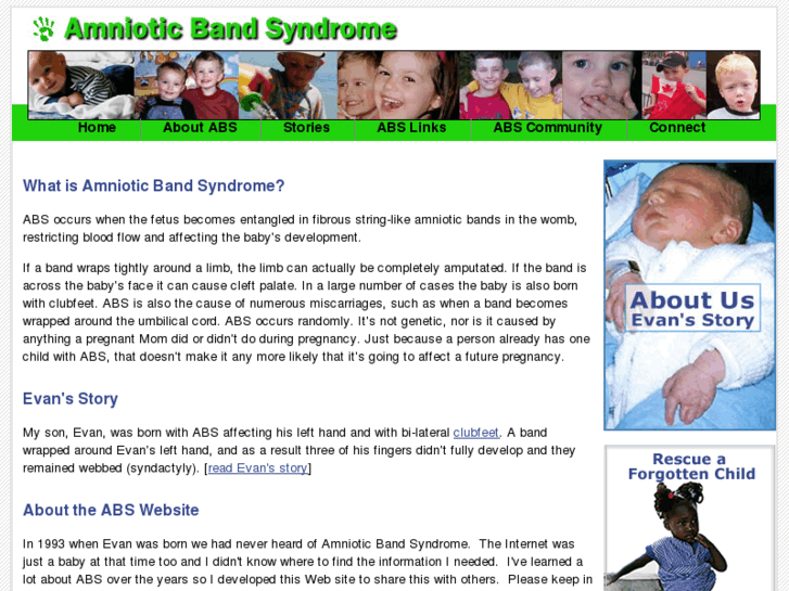 www.amnioticbandsyndrome.com