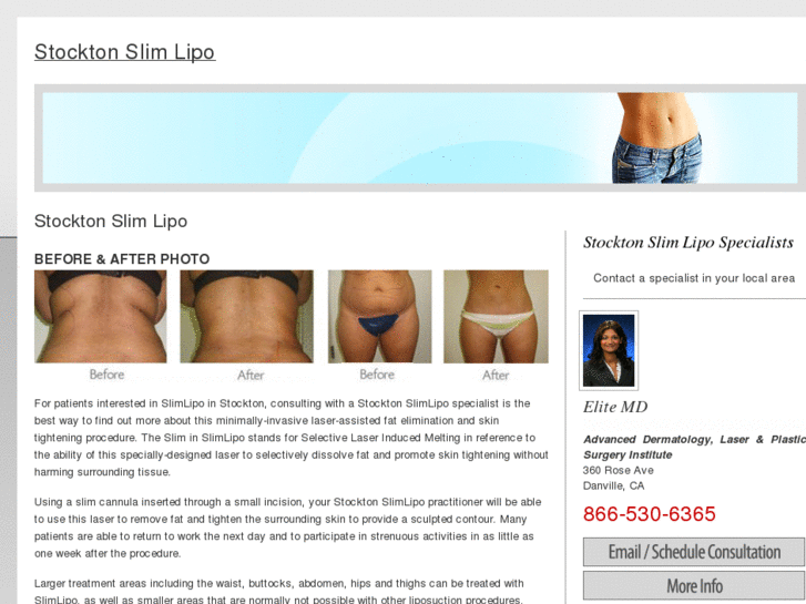 www.stocktonslimlipo.com