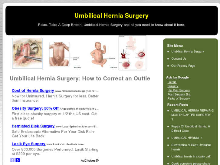 www.umbilicalherniasurgery.net