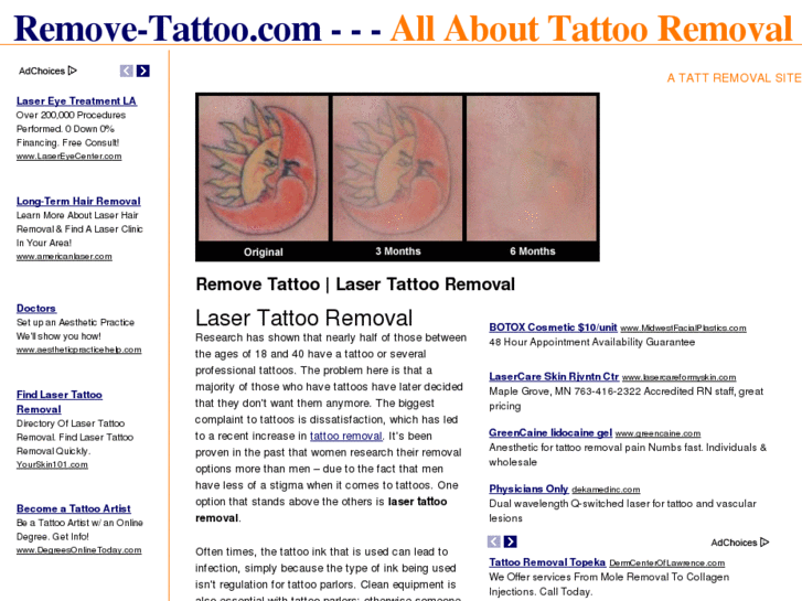 www.remove-tattoo.com