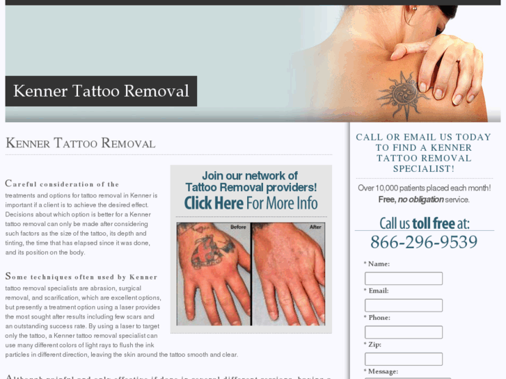 www.kennertattooremoval.com