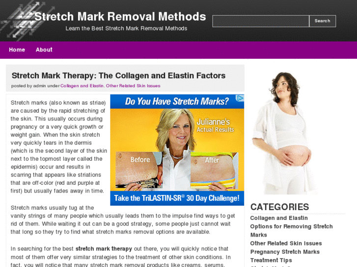 www.stretchmarkremovalmethods.com