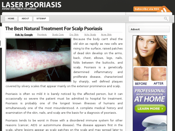 www.laserpsoriasis.com