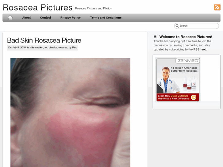 www.rosacea-pictures.com