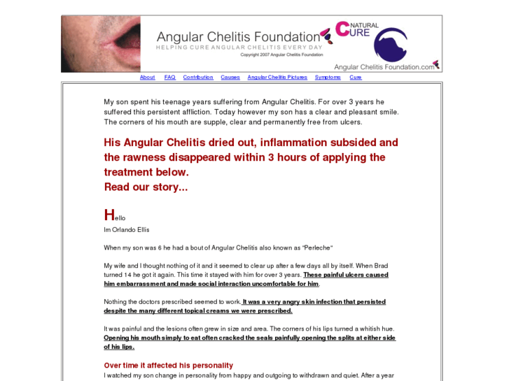 www.angular-cheilitis-remedy.com