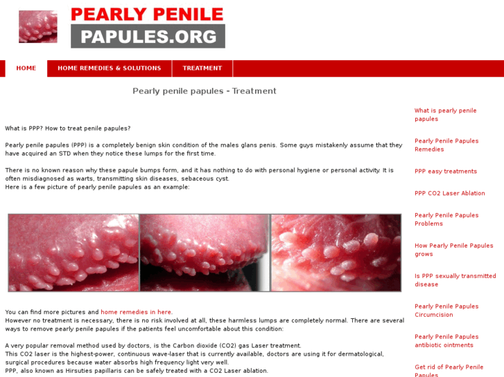 www.pearlypenilepapules.org