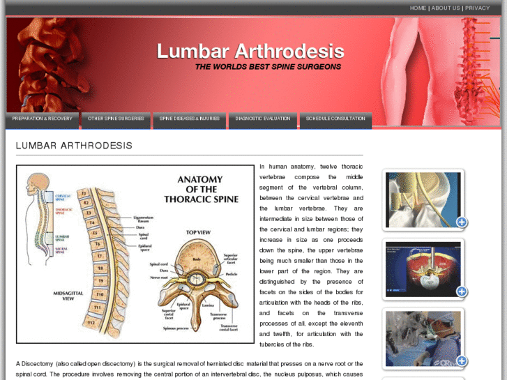 www.lumbararthrodesis.info