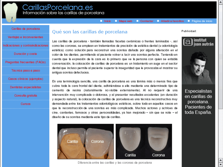 www.carillasporcelana.es