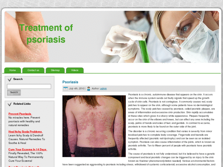 www.treatmentofpsoriasis.info