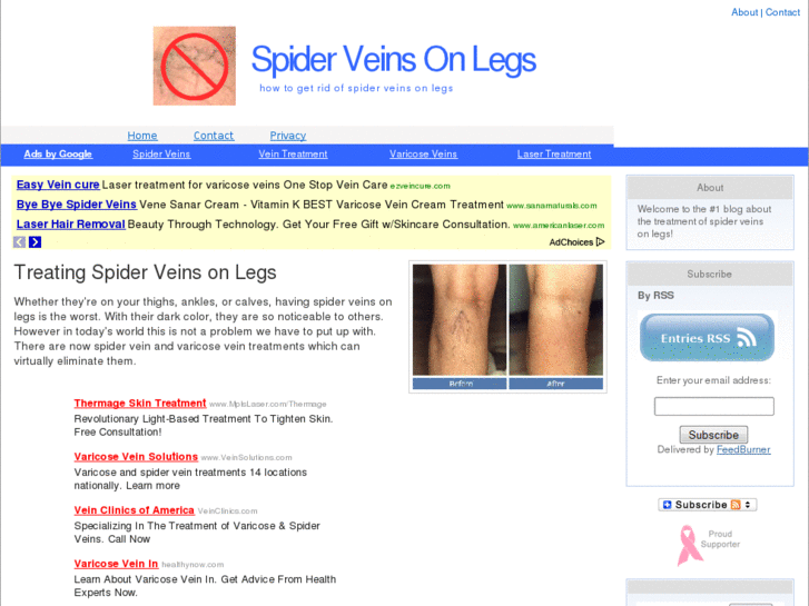 www.spiderveinsonlegs.com