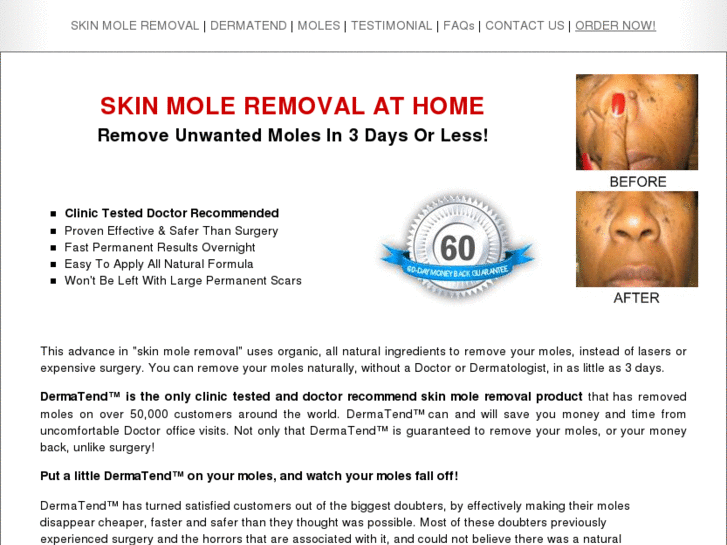 www.skinmole-removal.com