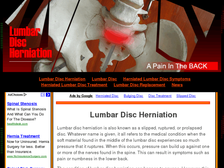 www.lumbardischerniation.com