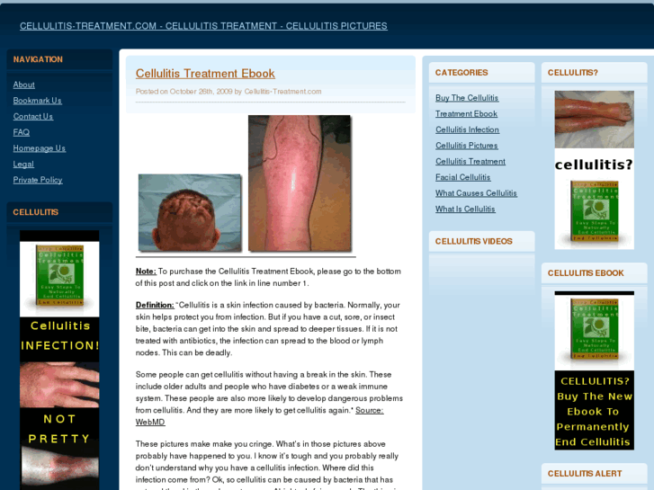 www.cellulitis-treatment.com