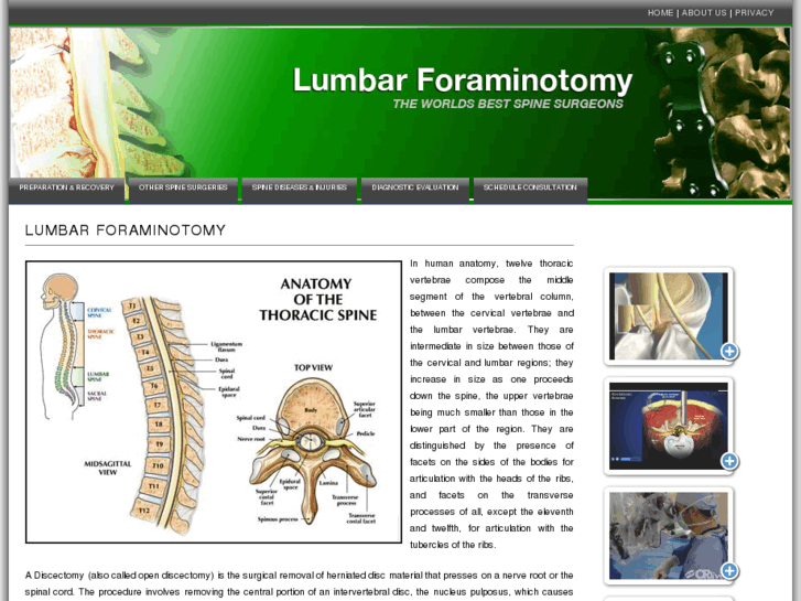 www.lumbarforaminotomy.info