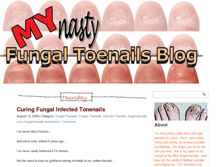 www.fungaltoenailsblog.com